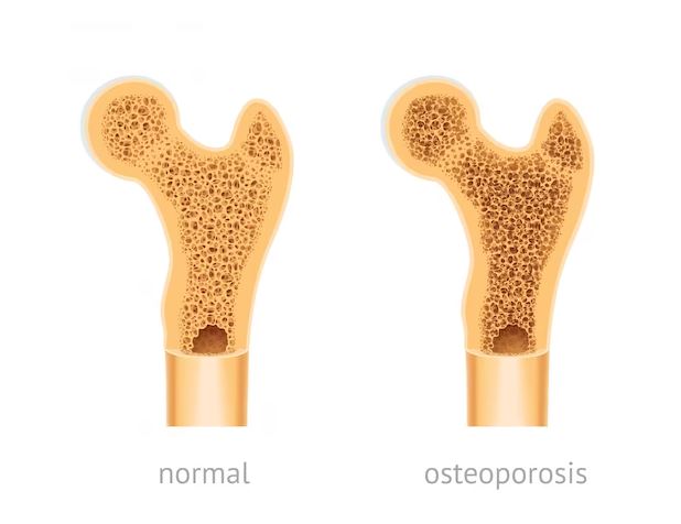 Osteoporosis ICD-10